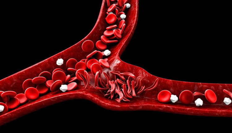 Jornada De Concientizaci N Y Prevenci N De La Anemia Falciforme Grupo R Multimedio