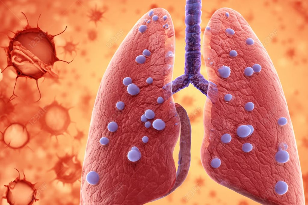 A escala global, durante el año 2024 se notificaron 977 mil casos, una cifra que casi multiplica por seis los 167 mil 407 reportados en 2023.