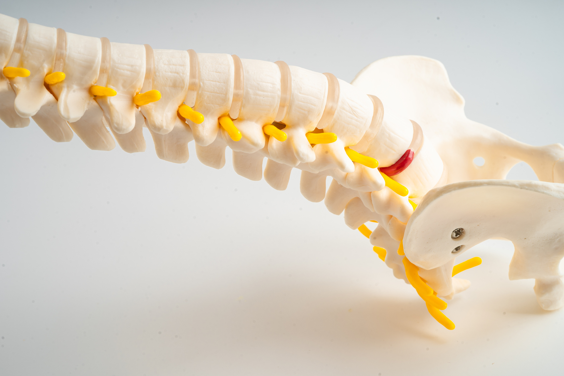 Modelo de fragmento de disco herniado