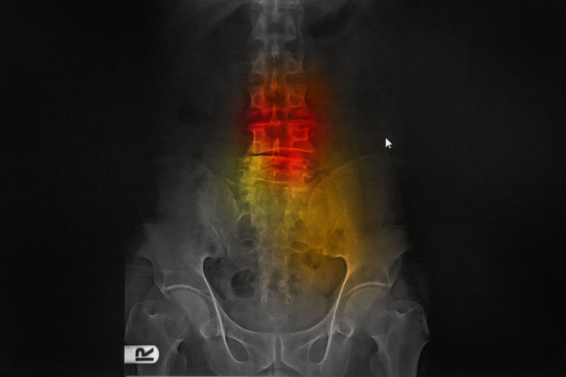 Radiografía Lumbar