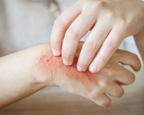 Atendiendo la sintomatología, estos varían según la zona afectada