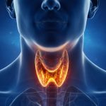 Es un trastorno autoinmunitario crónico donde el sistema inmunitario ataca la glándula tiroides