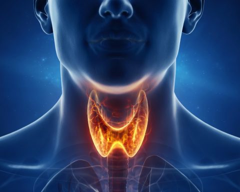 Es un trastorno autoinmunitario crónico donde el sistema inmunitario ataca la glándula tiroides